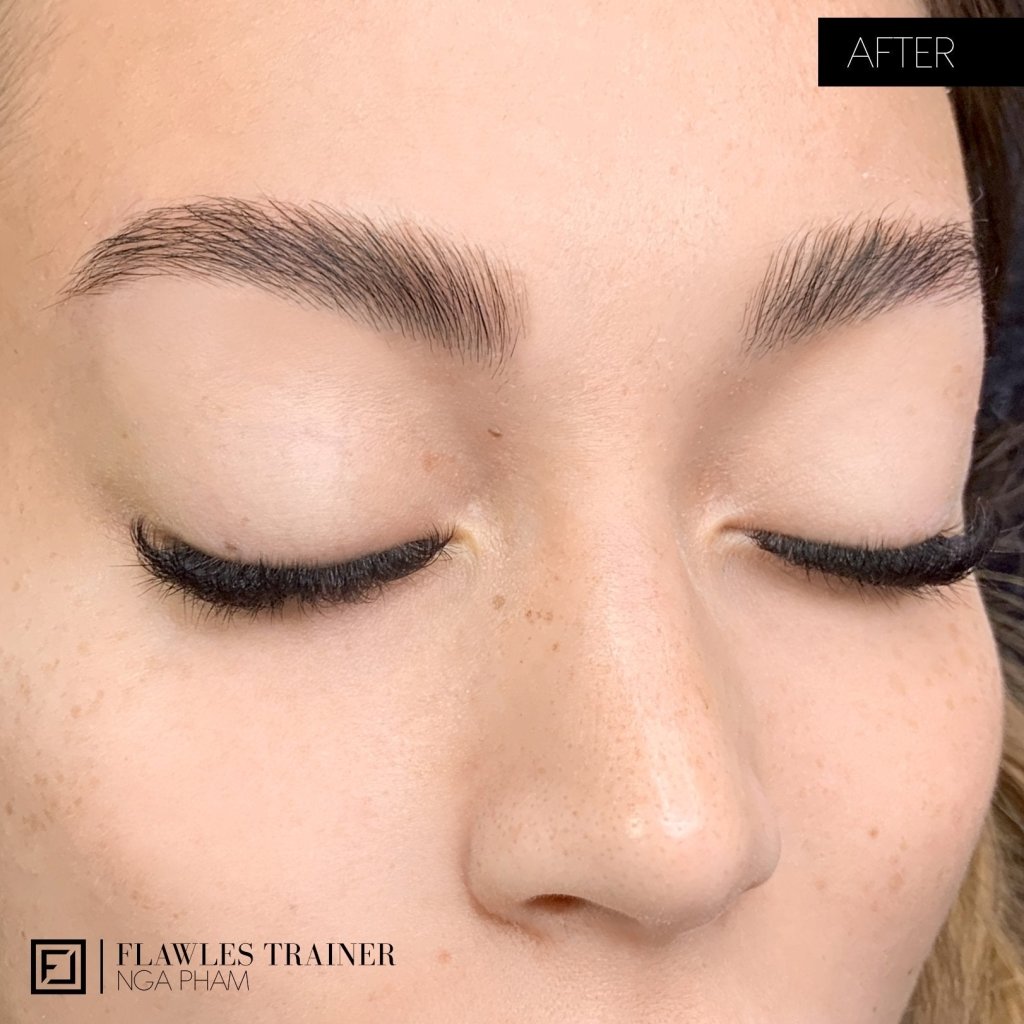 browlift nachher foto